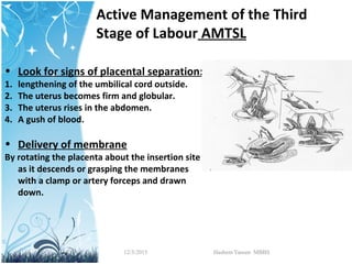 Active management of the third stage of labour | PPT