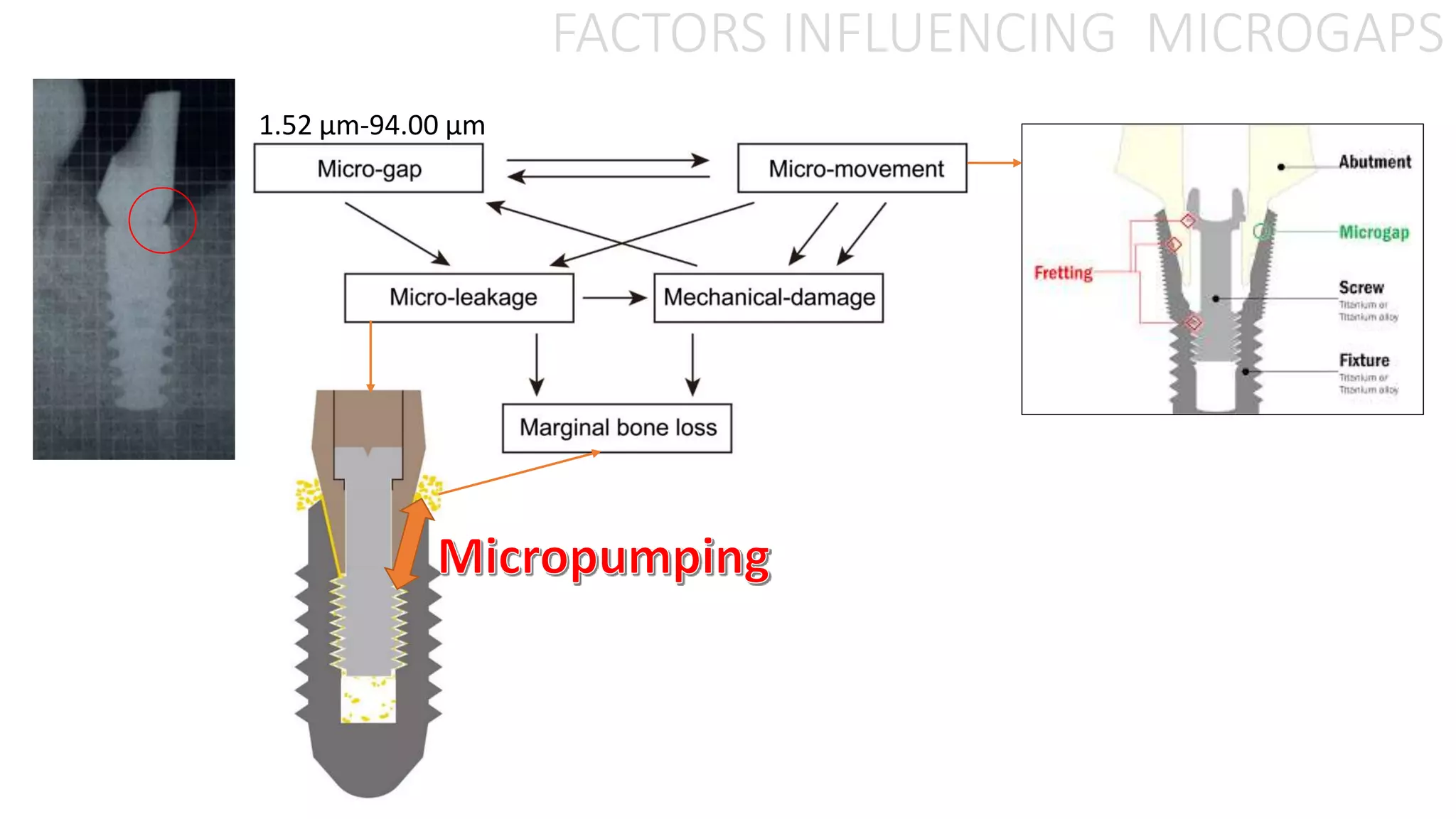 1.52 µm-94.00 µm
FACTORS INFLUENCING MICROGAPS
 
