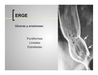 ERGE
Ulceras y erosiones:

Puntiformes
Lineales
Estrelladas

 