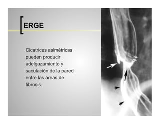 ERGE
Cicatrices asimétricas
pueden producir
adelgazamiento y
saculación de la pared
entre las áreas de
fibrosis

 
