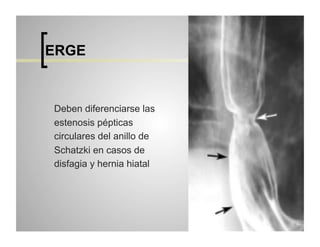 ERGE

Deben diferenciarse las
estenosis pépticas
circulares del anillo de
Schatzki en casos de
disfagia y hernia hiatal

 