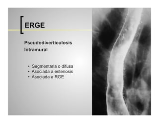 ERGE
Pseudodiverticulosis
Intramural
•  Segmentaria o difusa
•  Asociada a estenosis
•  Asociada a RGE

 