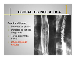 Esofagograma | PDF