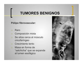 TUMORES BENIGNOS
Pólipo fibrovascular:
 
 
 

 
 

Raro
Composición mixta
Se sitúa cerca al músculo
cricofaríngeo
Crecimiento lento
Masa en forma de
“salchicha” que se expande
al lumen esofágico

 