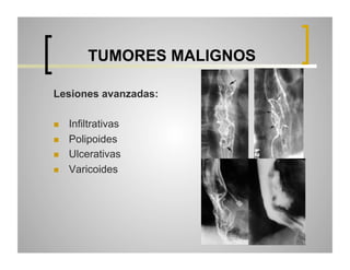 TUMORES MALIGNOS
Lesiones avanzadas:
 
 
 
 

Infiltrativas
Polipoides
Ulcerativas
Varicoides

 