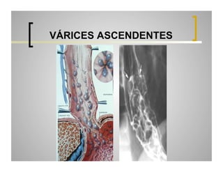 VÁRICES ASCENDENTES

 