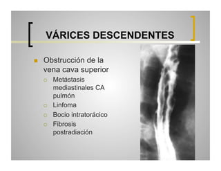 VÁRICES DESCENDENTES
 

Obstrucción de la
vena cava superior
 

 
 
 

Metástasis
mediastinales CA
pulmón
Linfoma
Bocio intratorácico
Fibrosis
postradiación

 