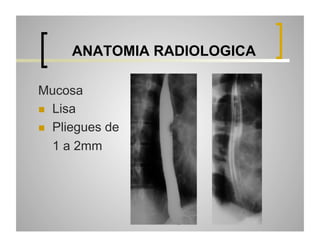 ANATOMIA RADIOLOGICA
Mucosa
  Lisa
  Pliegues de
1 a 2mm

 