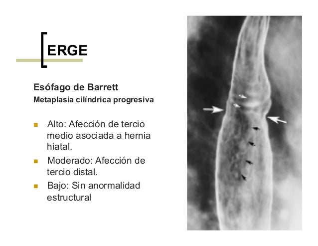 Arreglar la celulitis de las manos del ejercicio