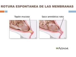 ROTURA ESPONTANEA DE LAS MEMBRANAS 