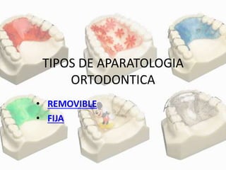 TIPOS DE APARATOLOGIA
ORTODONTICA
• REMOVIBLE
• FIJA
 