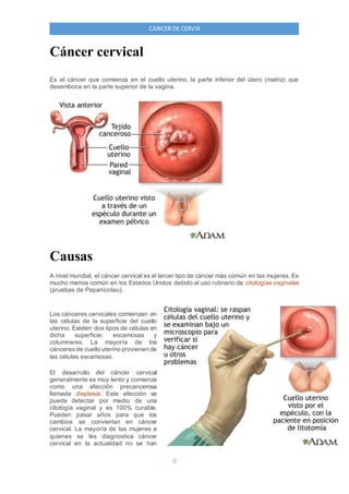 0
CANCER DE CERVIX
Cáncer cervical
Es el cáncer que comienza en el cuello uterino, la parte inferior del útero (matriz) que
desemboca en la parte superior de la vagina.
Causas
A nivel mundial, el cáncer cervical es el tercer tipo de cáncer más común en las mujeres. Es
mucho menos común en los Estados Unidos debido al uso rutinario de citologías vaginales
(pruebas de Papanicolau).
Los cánceres cervicales comienzan en
las células de la superficie del cuello
uterino. Existen dos tipos de células en
dicha superficie: escamosas y
columnares. La mayoría de los
cánceresde cuello uterino provienen de
las células escamosas.
El desarrollo del cáncer cervical
generalmente es muy lento y comienza
como una afección precancerosa
llamada displasia. Esta afección se
puede detectar por medio de una
citología vaginal y es 100% curable.
Pueden pasar años para que los
cambios se conviertan en cáncer
cervical. La mayoría de las mujeres a
quienes se les diagnostica cáncer
cervical en la actualidad no se han
 