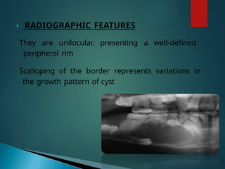 activity pathology (odontogenic cysts).pptx