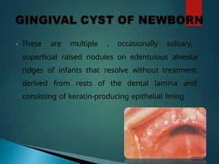 Superficial Ridges activity pathology (odontogenic cysts).pptx