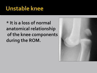 * It is a loss of normal
anatomical relationship
of the knee components
during the ROM.
 