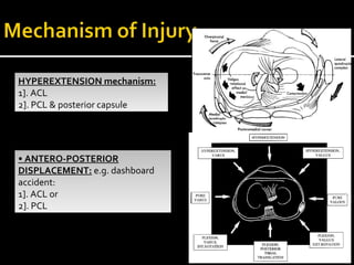 HYPEREXTENSION mechanism:
1]. ACL
2]. PCL & posterior capsule
HYPEREXTENSION mechanism:
1]. ACL
2]. PCL & posterior capsule
• ANTERO-POSTERIOR
DISPLACEMENT: e.g. dashboard
accident:
1]. ACL or
2]. PCL
• ANTERO-POSTERIOR
DISPLACEMENT: e.g. dashboard
accident:
1]. ACL or
2]. PCL
 