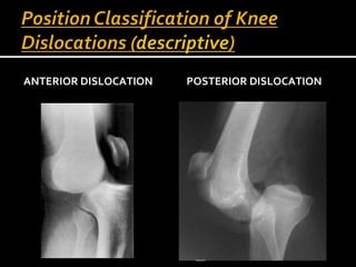 ANTERIOR DISLOCATION POSTERIOR DISLOCATION
 