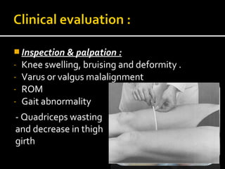 Inspection & palpation :
- Knee swelling, bruising and deformity .
- Varus or valgus malalignment
- ROM
- Gait abnormality
- Quadriceps wasting
and decrease in thigh
girth
 