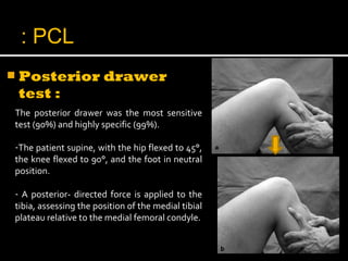  Posterior drawer
test :
The posterior drawer was the most sensitive
test (90%) and highly specific (99%).
-The patient supine, with the hip flexed to 45°,
the knee flexed to 90°, and the foot in neutral
position.
- A posterior- directed force is applied to the
tibia, assessing the position of the medial tibial
plateau relative to the medial femoral condyle.
PCL:
 