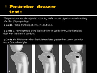  Posterior drawer
test :
The posterior translation is graded according to the amount of posterior subluxation of
the tibia (Noyes grading):
1-Grade I : Tibial translation between 1 and 5mm.
2-Grade II : Posterior tibial translation is between 5 and 10 mm, and the tibia is
flush with the femoral condyles.
3-Grade III : This is seen when the tibia translates greater than 10 mm posterior
to the femoral condyles.
 