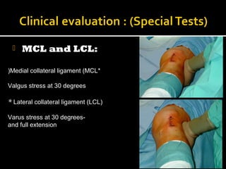  MCL and LCL:
*Medial collateral ligament (MCL(
Valgus stress at 30 degrees
* Lateral collateral ligament (LCL(
-Varus stress at 30 degrees
and full extension
 