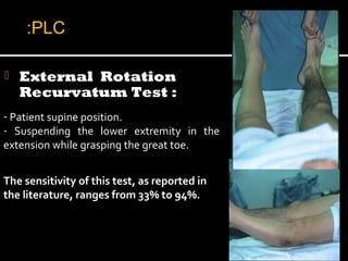 - Patient supine position.
- Suspending the lower extremity in the
extension while grasping the great toe.
The sensitivity of this test, as reported in
the literature, ranges from 33% to 94%.
 External Rotation
Recurvatum Test :
PLC:
 