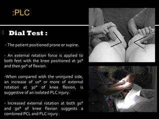  Dial Test :
- The patient positioned prone or supine.
- An external rotation force is applied to
both feet with the knee positioned at 30°
and then 90° of flexion.
-When compared with the uninjured side,
an increase of 10° or more of external
rotation at 30° of knee flexion, is
suggestive of an isolated PLC injury.
- Increased external rotation at both 30°
and 90° of knee flexion suggests a
combined PCL and PLC injury .
PLC:
 