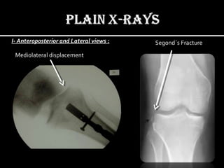 I- Anteroposterior and Lateral views :
Mediolateral displacement
Segond`s Fracture
 