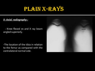 II- Axial radiography :
- Knee flexed 70 and X ray beam
angled superiorly.
-The location of the tibia in relation
to the femur as compared with the
contralateral normal side.
 