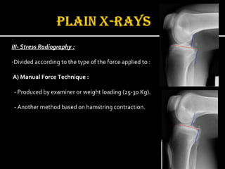 III- Stress Radiography :
-Divided according to the type of the force applied to :
A) Manual Force Technique :
- Produced by examiner or weight loading (25-30 Kg).
- Another method based on hamstring contraction.
 