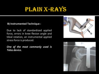 B) Instrumented Technique :
Due to lack of standardized applied
force, errors in knee flexion angle and
tibial rotation, an instrumental applied
stress force is produced.
One of the most commonly used is
Telos device.
 