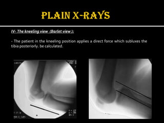 IV- The kneeling view (Barlet view ):
- The patient in the kneeling position applies a direct force which subluxes the
tibia posteriorly. be calculated.
 