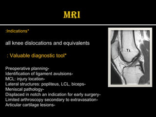 T1
*Indications:
all knee dislocations and equivalents
*Valuable diagnostic tool:
-Preoperative planning
-Identification of ligament avulsions
-MCL: injury location
-Lateral structures: popliteus, LCL, biceps
-Meniscal pathology
-Displaced in notch an indication for early surgery
-Limited arthroscopy secondary to extravasation
-Articular cartilage lesions
 