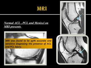 Normal ACL , PCL and Menisci on
MRI presents
T1
T2
MRI was found to be 99% accurate and
sensitive diagnosing the presence of ACL
and PCL injury.
 