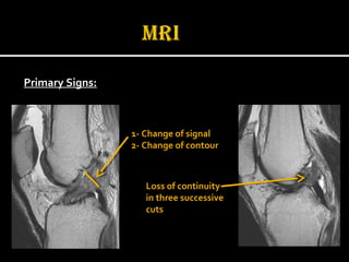 Primary Signs:
1- Change of signal
2- Change of contour
Loss of continuityLoss of continuity
in three successivein three successive
cutscuts
 