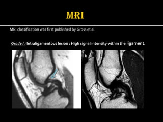 MRI classification was first published by Gross et al.
Grade I : Intraligamentous lesion : High signal intensity within the ligament.
 