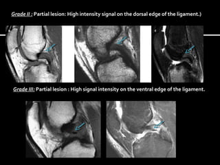 Grade II : Partial lesion: High intensity signal on the dorsal edge of the ligament.)
Grade III: Partial lesion : High signal intensity on the ventral edge of the ligament.
 