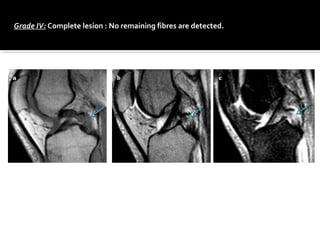Grade IV: Complete lesion : No remaining fibres are detected.
 