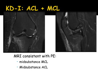 MRI consistent with PE:
• midsubstance MCL
• Midsubstance ACL
 