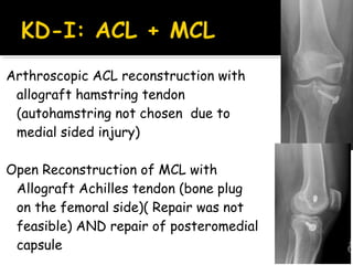 Arthroscopic ACL reconstruction with
allograft hamstring tendon
(autohamstring not chosen due to
medial sided injury)
Open Reconstruction of MCL with
Allograft Achilles tendon (bone plug
on the femoral side)( Repair was not
feasible) AND repair of posteromedial
capsule
 