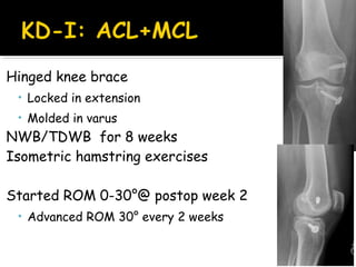 Hinged knee brace
• Locked in extension
• Molded in varus
NWB/TDWB for 8 weeks
Isometric hamstring exercises
Started ROM 0-30°@ postop week 2
• Advanced ROM 30° every 2 weeks
 