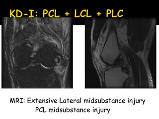 MRI: Extensive Lateral midsubstance injury
PCL midsubstance injury
 