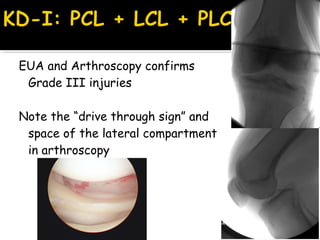 EUA and Arthroscopy confirms
Grade III injuries
Note the “drive through sign” and
space of the lateral compartment
in arthroscopy
 