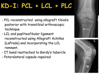 - PCL reconstructed using allograft tibialis
posterior with transtibial arthroscopic
technique
- LCL and popliteofibular ligament
reconstructed using Allograft Achilles
(LaPrade) and incorporating the LCL
remnant.
- IT band reattached to Gerdy’s tubercle
- Poterolateral capsule repaired
 