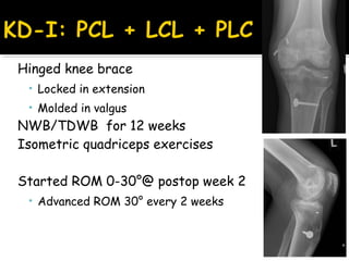 Hinged knee brace
• Locked in extension
• Molded in valgus
NWB/TDWB for 12 weeks
Isometric quadriceps exercises
Started ROM 0-30°@ postop week 2
• Advanced ROM 30° every 2 weeks
 