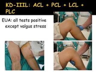 EUA: all tests positive
except valgus stress
 