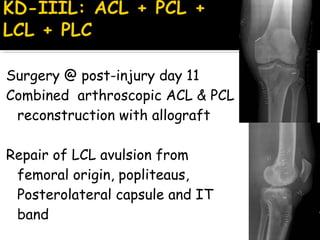 Surgery @ post-injury day 11
Combined arthroscopic ACL & PCL
reconstruction with allograft
Repair of LCL avulsion from
femoral origin, popliteaus,
Posterolateral capsule and IT
band
 