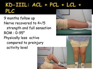9 months follow up
Nerve recovered to 4+/5
strength and full sensation
ROM : 0-95°
Physically less active
compared to preinjury
activity level
 