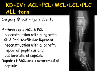 Surgery @ post-injury day 18
Arthroscopic ACL & PCL
reconstruction with allografts
LCL & Popliteofibular ligament
reconstruction with allograft,
repair of popliteus and
posterolateral capsule
Repair of MCL and posteromedial
capsule
 