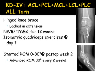 Hinged knee brace
• Locked in extension
NWB/TDWB for 12 weeks
Isometric quadriceps exercises @
day 1
Started ROM 0-30°@ postop week 2
• Advanced ROM 30° every 2 weeks
 